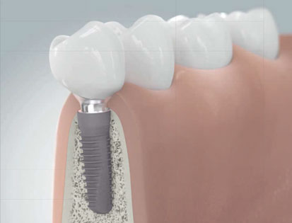 Zahnimplantat, Implantataufbau (Zwischenstück) und Zahnkrone