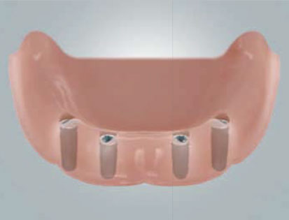 Zahnloser Unterkiefer mit vier Implantaten