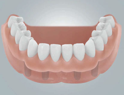Wiederherstellung der ganzen Zahnreihe am Beispiel des Unterkiefers.